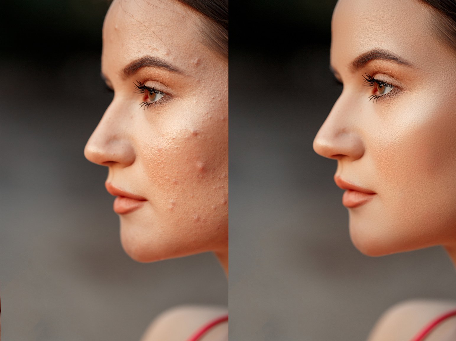 face with acne and pimples close-up. shallow DOF. selective focus. before and after retouching(after applying acne remedies).